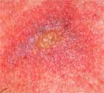 Spider Bite